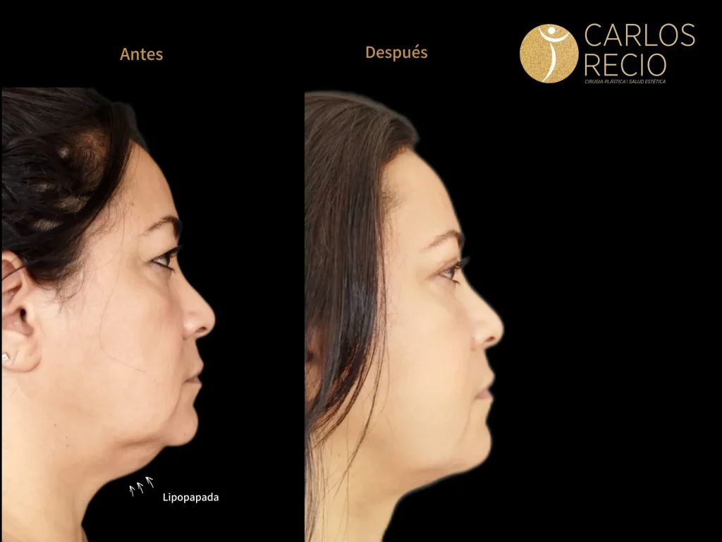 Lipopapada: qué es, cómo se elimina y qué esperar antes y después del procedimiento lipopapada